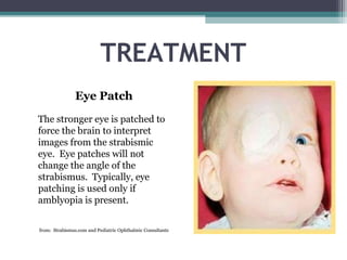 TREATMENT
Eye Patch
The stronger eye is patched to
force the brain to interpret
images from the strabismic
eye. Eye patches will not
change the angle of the
strabismus. Typically, eye
patching is used only if
amblyopia is present.
from: Strabismus.com and Pediatric Ophthalmic Consultants
 