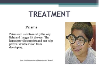 TREATMENT
Prisms
Prisms are used to modify the way
light and images hit the eye. The
lenses provide comfort and can help
prevent double vision from
developing.
from: Strabismus.com and Optometrists Network
 