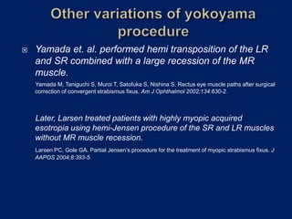  Yamada et. al. performed hemi transposition of the LR
and SR combined with a large recession of the MR
muscle.
Yamada M, Taniguchi S, Muroi T, Satofuka S, Nishina S. Rectus eye muscle paths after surgical
correction of convergent strabismus fixus. Am J Ophthalmol 2002;134:630-2.
Later, Larsen treated patients with highly myopic acquired
esotropia using hemi-Jensen procedure of the SR and LR muscles
without MR muscle recession.
Larsen PC, Gole GA. Partial Jensen’s procedure for the treatment of myopic strabismus fixus. J
AAPOS 2004;8:393-5.
 