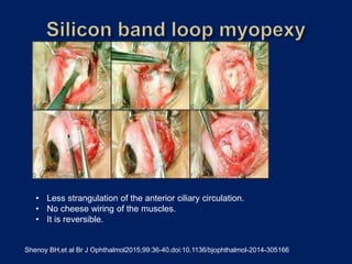 Shenoy BH,et al Br J Ophthalmol2015;99:36-40.doi:10.1136/bjophthalmol-2014-305166
• Less strangulation of the anterior ciliary circulation.
• No cheese wiring of the muscles.
• It is reversible.
 