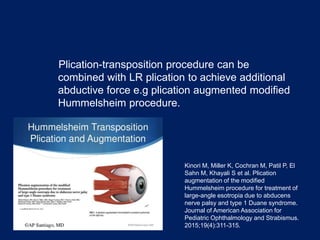 Plication-transposition procedure can be
combined with LR plication to achieve additional
abductive force e.g plication augmented modified
Hummelsheim procedure.
Kinori M, Miller K, Cochran M, Patil P, El
Sahn M, Khayali S et al. Plication
augmentation of the modified
Hummelsheim procedure for treatment of
large-angle esotropia due to abducens
nerve palsy and type 1 Duane syndrome.
Journal of American Association for
Pediatric Ophthalmology and Strabismus.
2015;19(4):311-315.
 