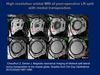 Chaudhuri Z, Demer J. Magnetic resonance imaging of bilateral split lateral
rectus transposition to the medial globe. Graefes Arch Clin Exp Ophthalmol.
2015;253(9):1587-1590
 