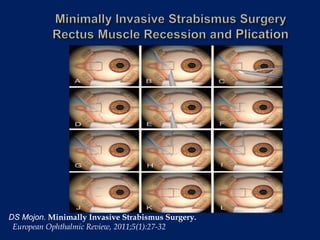 DS Mojon. Minimally Invasive Strabismus Surgery.
European Ophthalmic Review, 2011;5(1):27-32
 