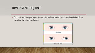 STRABISMUS.pptx