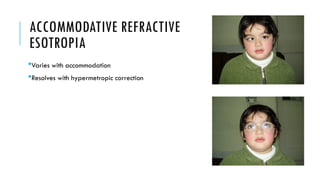 Refractive Strabismus Strabismus and it's evaluation and treatment | PPTX