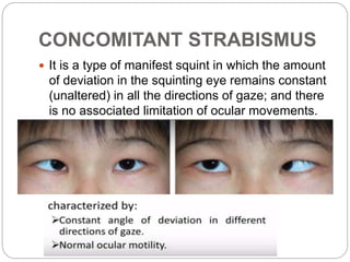Strabismus - Dr. Halal | PPTX