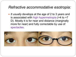 Strabismus - Dr. Halal | PPTX