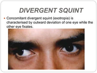 Strabismus - Dr. Halal | PPTX
