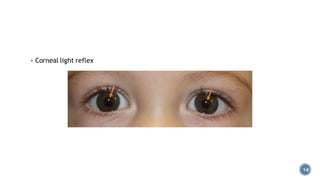 14
▪ Corneal light reflex
 