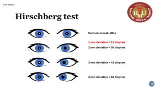 Hirschberg test
17
Core Subject
 