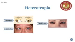 Heterotropia
Exotropia
Esotropia
Hypertropia
31
Core Subject
 