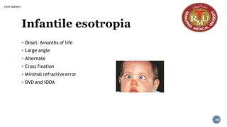 Infantile esotropia
▪ Onset– 6months of life
▪ Large angle
▪ Alternate
▪ Cross fixation
▪ Minimal refractive error
▪ DVD and IOOA
36
Core Subject
 