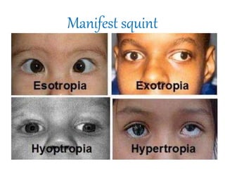 Manifest squint
 