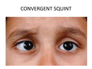 CONVERGENT SQUINT
 