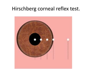 Hirschberg corneal reflex test.
 
