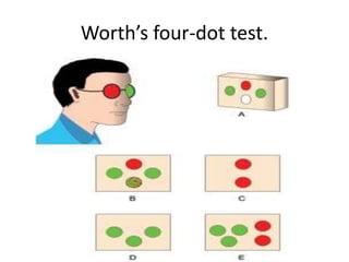 Worth’s four-dot test.
 