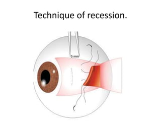 Technique of recession.
 