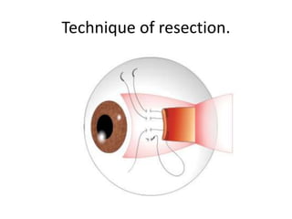 Technique of resection.
 