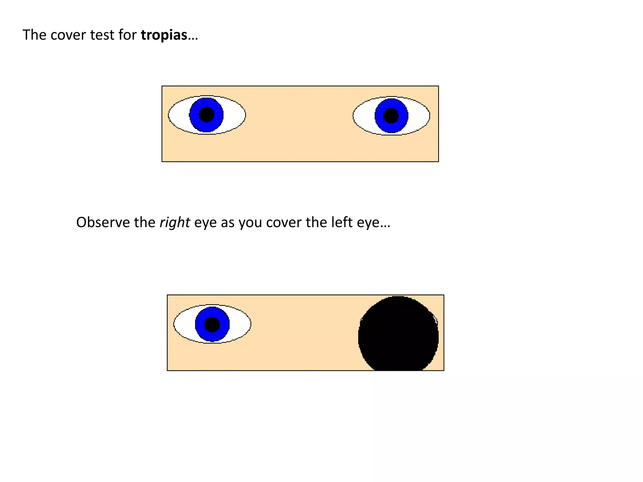 The cover test for tropias…
Observe the right eye as you cover the left eye…
 