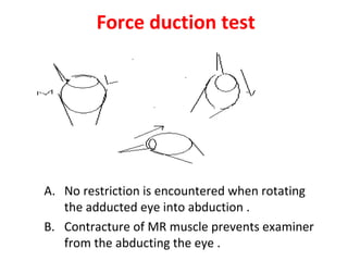 Strabismus by raju | PPT