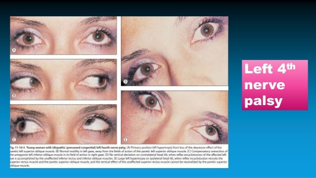 Strabismus demystified
