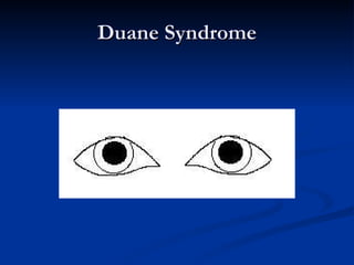 Duane Syndrome 