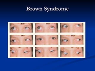 Brown Syndrome 