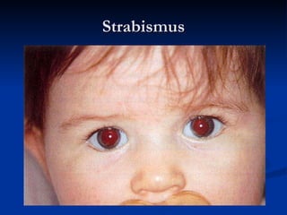 Strabismus 