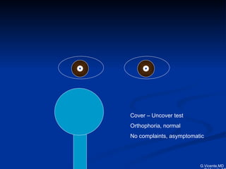 Cover – Uncover test Orthophoria, normal No complaints, asymptomatic G.Vicente,MD G.Vicente,MD 