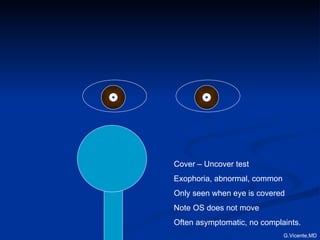 Cover – Uncover test Exophoria, abnormal, common Only seen when eye is covered Note OS does not move Often asymptomatic, no complaints. G.Vicente,MD 