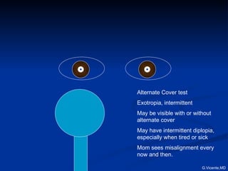 Alternate Cover test Exotropia, intermittent May be visible with or without alternate cover May have intermittent diplopia, especially when tired or sick Mom sees misalignment every now and then. G.Vicente,MD 