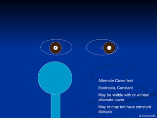 Alternate Cover test Exotropia, Constant May be visible with or without alternate cover May or may not have constant diplopia G.Vicente,MD 