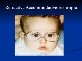 Refractive Accommodative Esotropia 