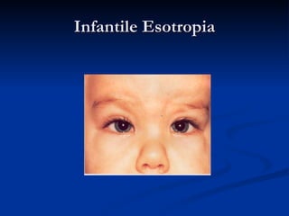 Infantile Esotropia 