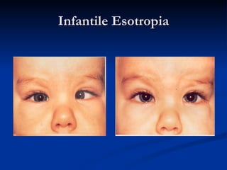 Infantile Esotropia 