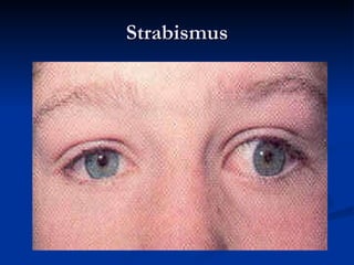 Strabismus 