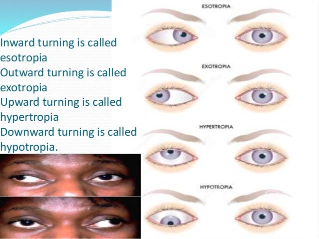 paralytic strabismus