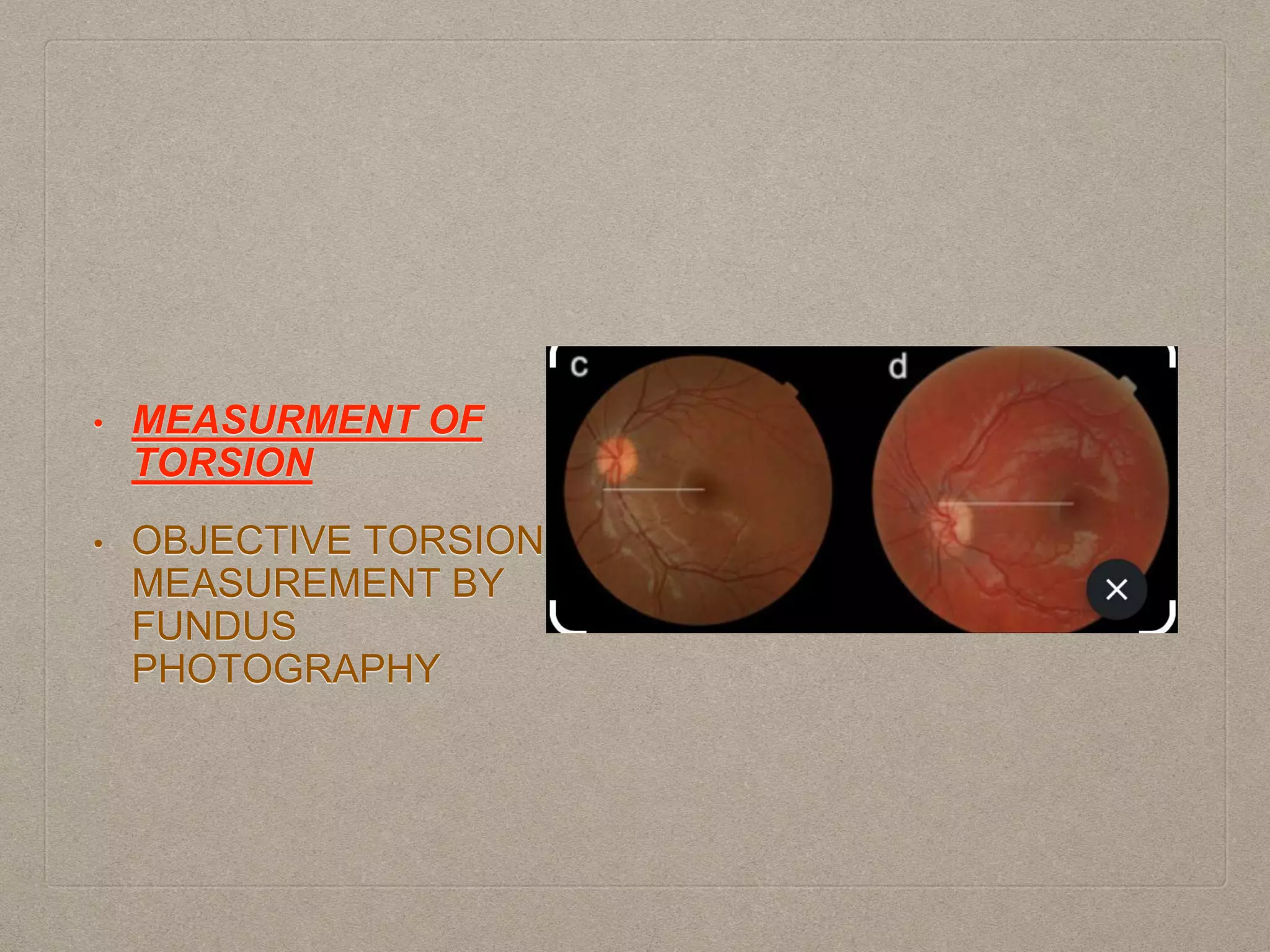 • MEASURMENT OF
TORSION
• OBJECTIVE TORSION
MEASUREMENT BY
FUNDUS
PHOTOGRAPHY
 