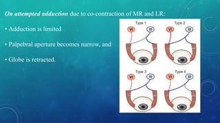 On attempted adduction due to co-contraction of MR and LR:
• Adduction is limited
• Palpebral aperture becomes narrow, and
• Globe is retracted.
 