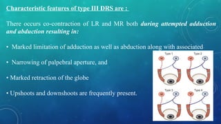 Characteristic features of type III DRS are :
There occurs co-contraction of LR and MR both during attempted adduction
and abduction resulting in:
• Marked limitation of adduction as well as abduction along with associated
• Narrowing of palpebral aperture, and
• Marked retraction of the globe
• Upshoots and downshoots are frequently present.
 