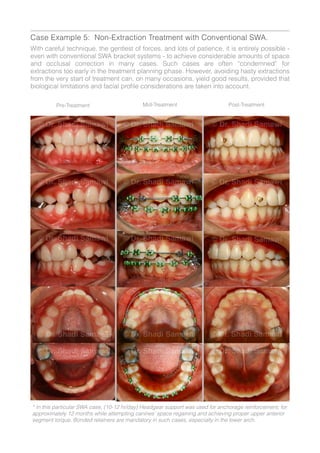 Swa Support Methods Straight-Wire Orthodontics (1st Edition) - 2014 - Shadi Samawi | PDF