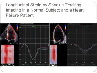 Longitudinal Strain by Speckle Tracking
Imaging in a Normal Subject and a Heart
Failure Patient
 