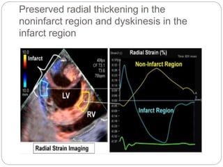 Myocardial Strain Imaging