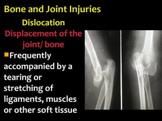 Dislocation
Displacement of the
joint/ bone
Frequently
accompanied by a
tearing or
stretching of
ligaments, muscles
or other soft tissue
 