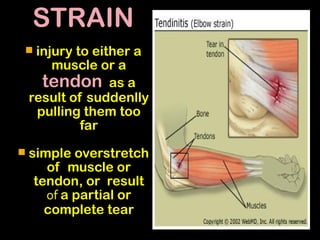 STRAIN
 injury to either a
muscle or a
tendon as a
result of suddenlly
pulling them too
far
 simple overstretch
of muscle or
tendon, or result
of a partial or
complete tear
 