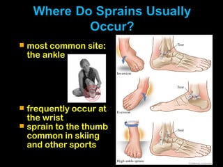  most common site:
the ankle
 frequently occur at
the wrist
 sprain to the thumb
common in skiing
and other sports
 