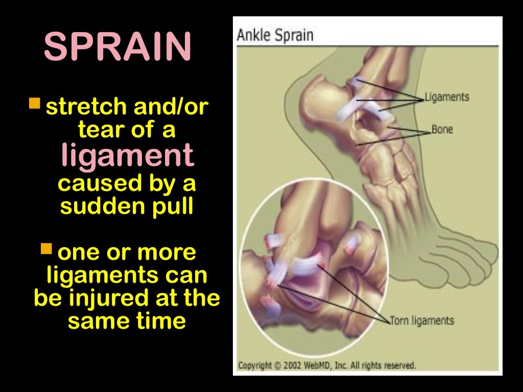Strain sprain fracture