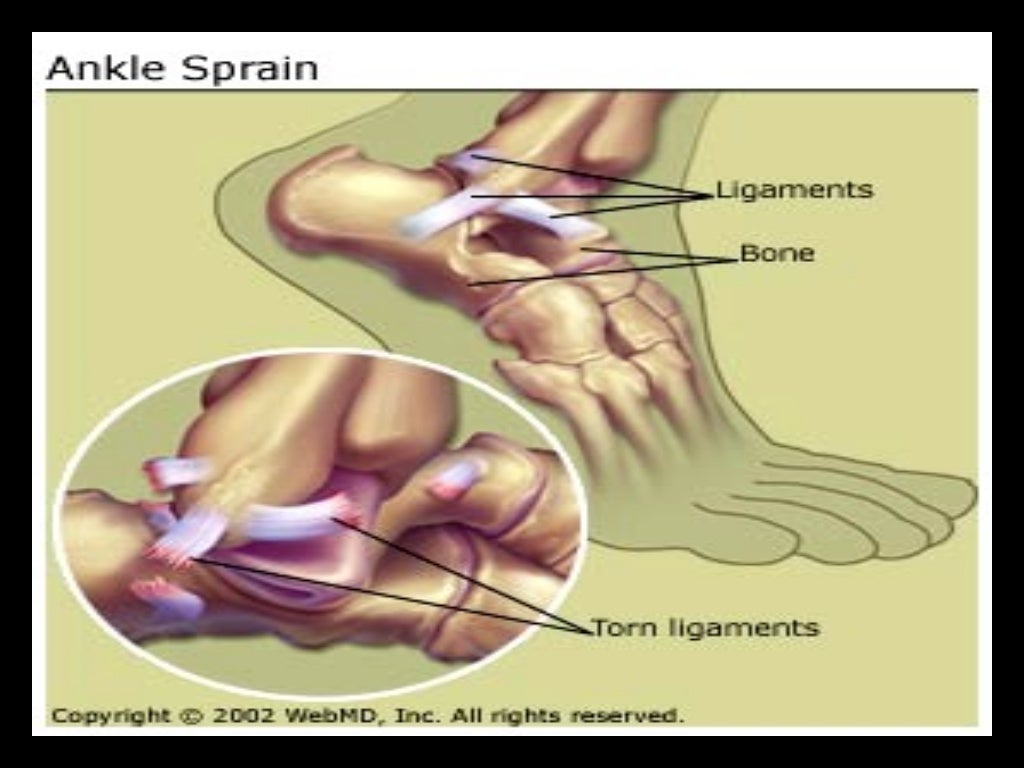 Strain sprain fracture