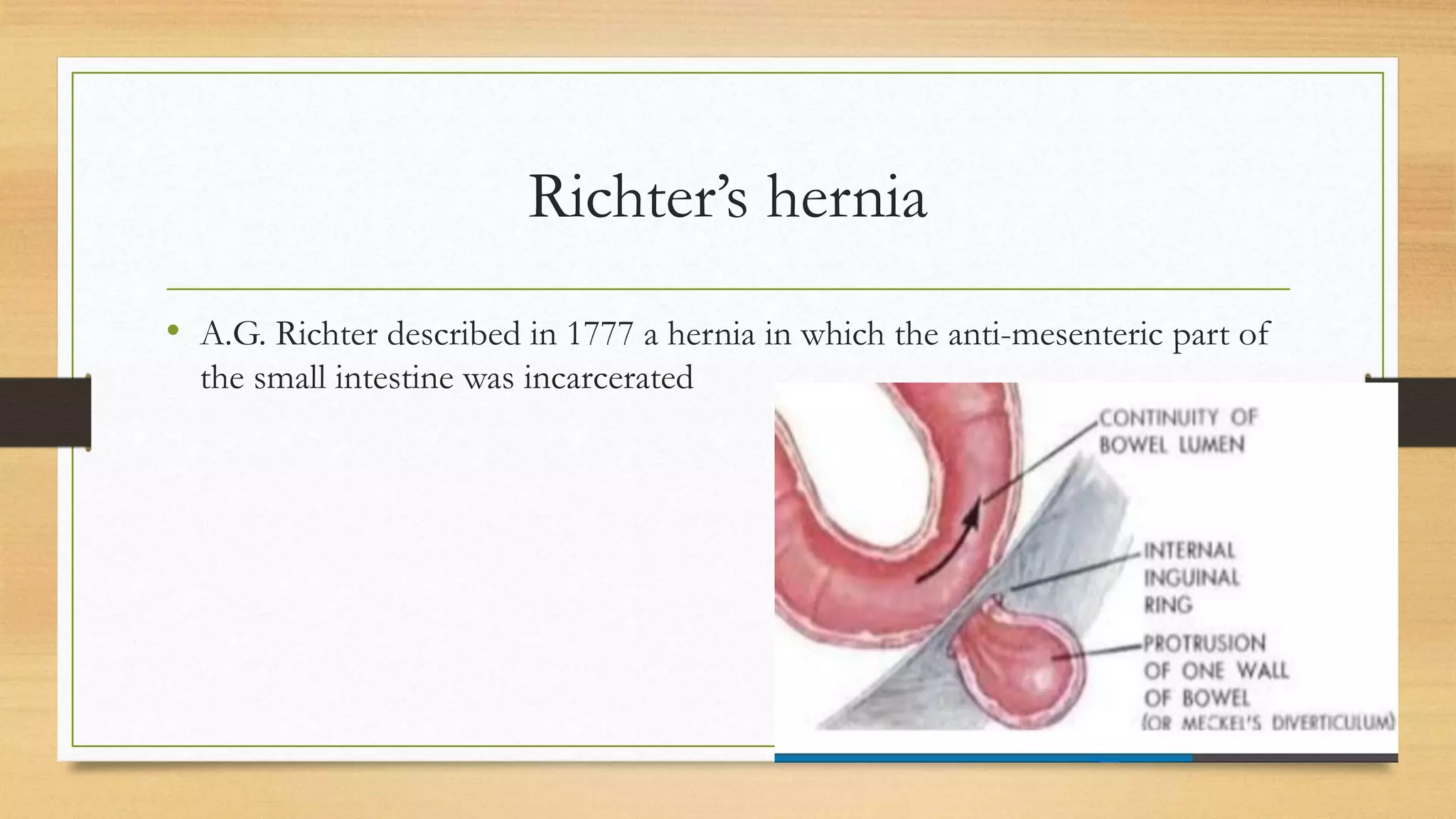 Strangulated Femoral Hernia PPTX