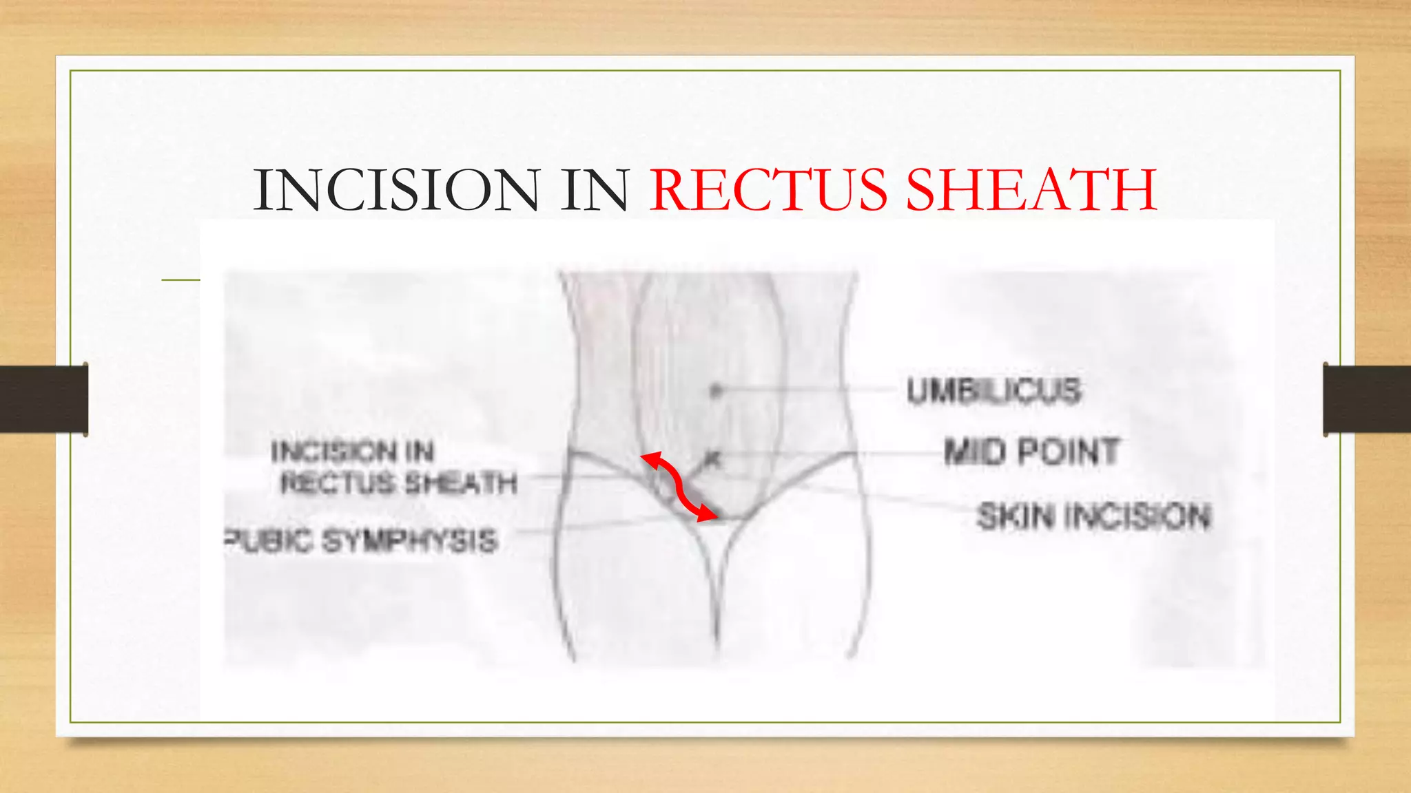 Strangulated Femoral Hernia PPTX